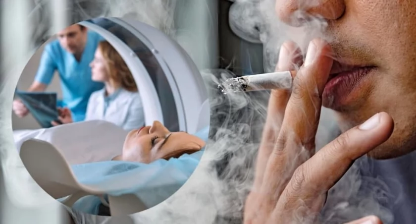 Do grupy ryzyka, która skorzysta z darmowego badania, należą przede wszystkim wieloletni palacze. To oni są najbardziej narażeni na raka płuca i dla nich tomografia może oznaczać wczesne wykrycie choroby